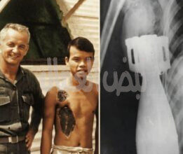 استقبل مستشفى بحري أمريكي قرب “دا نانغ” جندياً فيتنامياً شاباً يحمل داخل جسده قذيفة هاون عيار ٦٠ ملم لم تنفجر